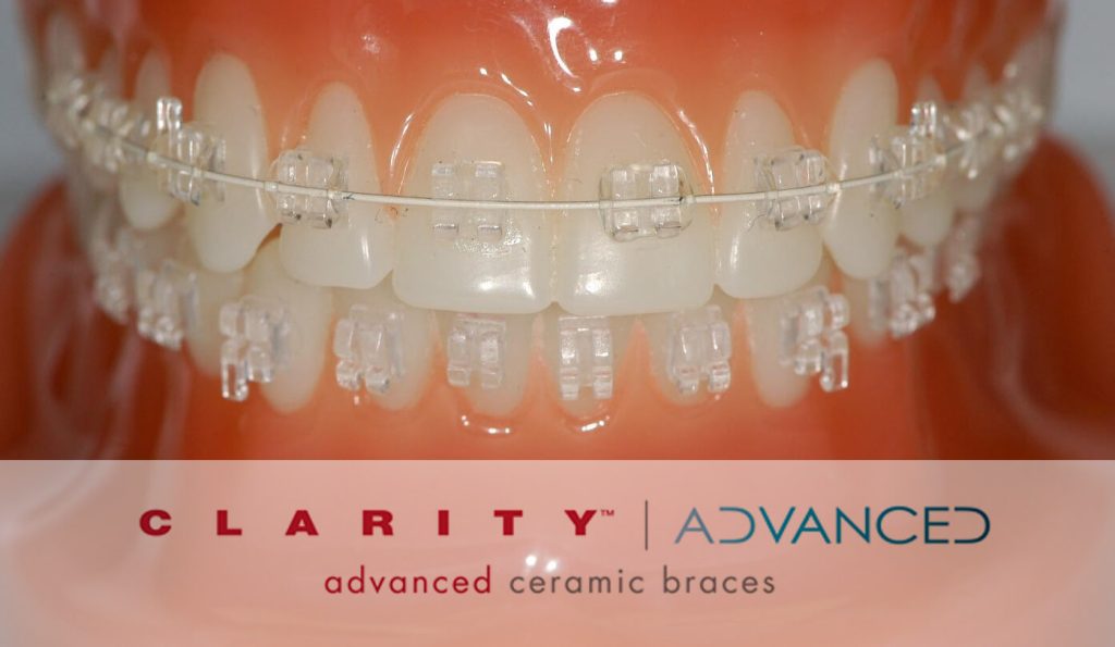 Clarity clear ceramic braces Finchley